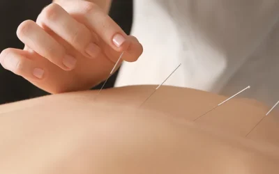 Akupunktur
