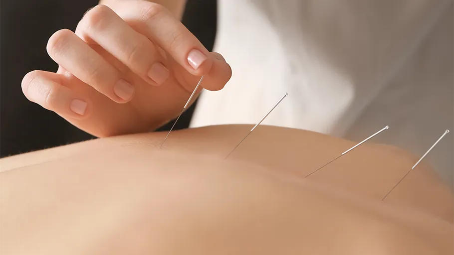Acupuncture Foto